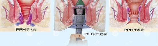 肛泰智能微创术pph