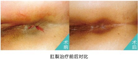 肛裂治疗前后对比