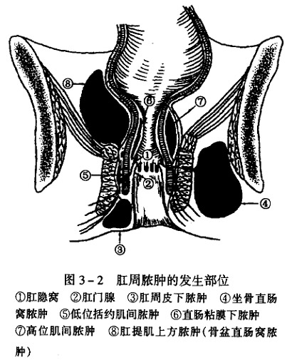 肛周脓肿的发生部位