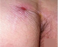肛门湿疹实例图