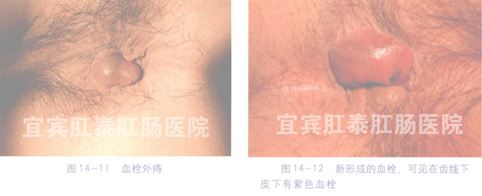外痔疮的症状图片
