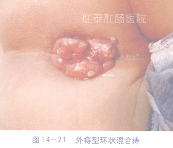 混合痔