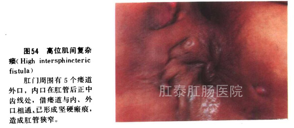 高位肌间复杂瘘