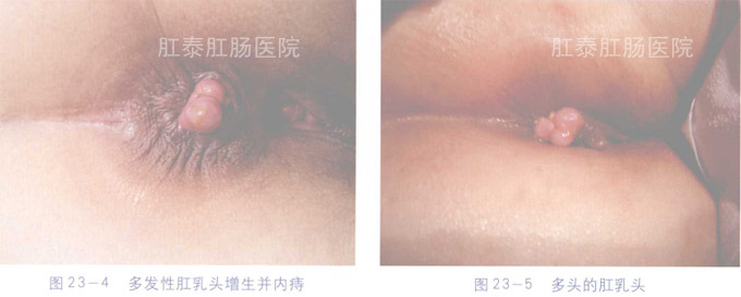 肛乳头肥大
