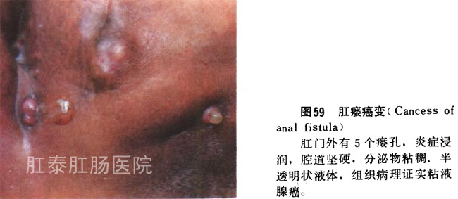 肛瘘病变