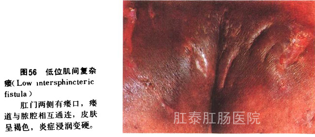 低位肌间单纯瘘
