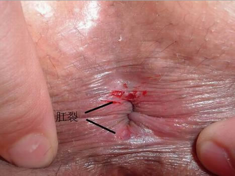 肛裂图片