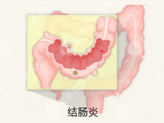 结肠炎