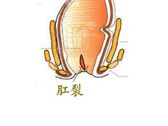 肛裂