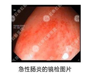 急性肠炎