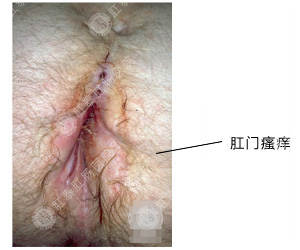 肛门瘙痒
