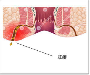 肛瘘