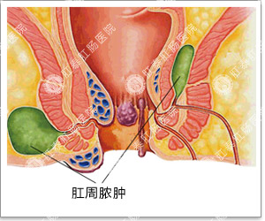 肛周脓肿