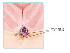 肛门湿疹
