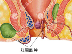 肛周脓肿
