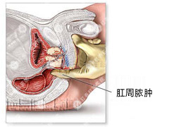 肛周脓肿