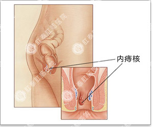 内痔