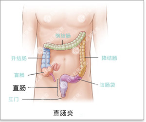 直肠炎