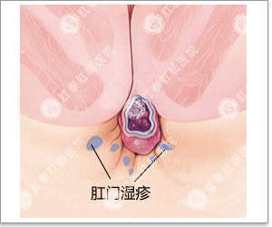 肛门湿疹
