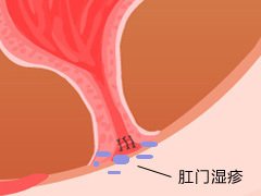 宜宾肛门湿疹有哪些症状表现?