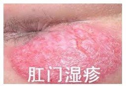 宜宾肛门湿疹该如何预防? 