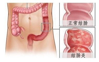 宜宾造成结肠炎的主要原因有哪些?