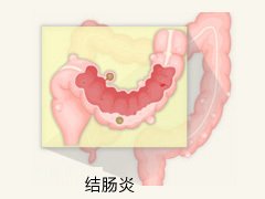 宜宾结肠炎不治有哪些危害?