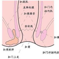 宜宾肛窦炎不治会有哪些危害?