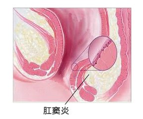 宜宾肛窦炎的临床表现有哪些? 