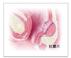 宜宾造成肛窦炎的原因有哪些? 
