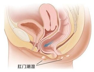 宜宾引起肛门潮湿的原因有哪些?