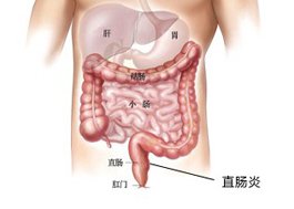 宜宾直肠炎有哪些常见类型?
