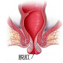 宜宾治疗脱肛哪家医院好?