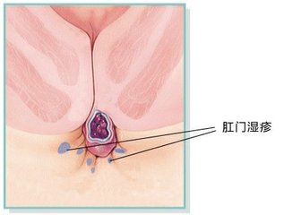 宜宾肛门湿疹不治有哪些危害? 