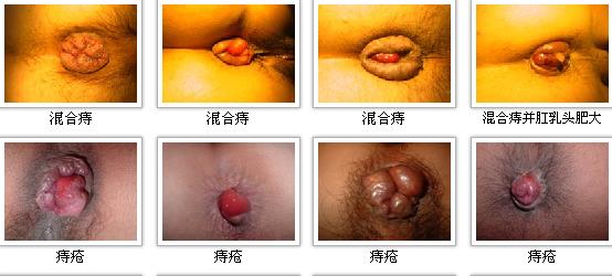 痔疮的症状